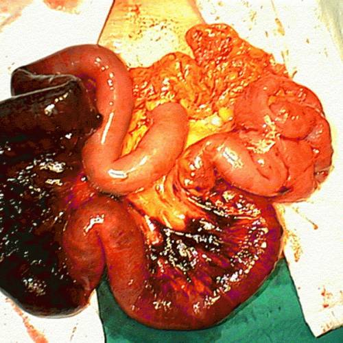 Hernia estrangulada