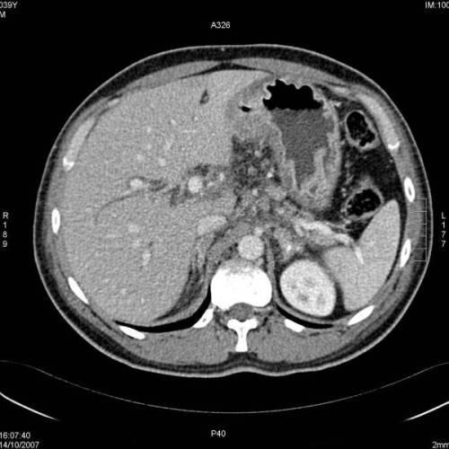 Cáncer gástrico, curvatura menor
