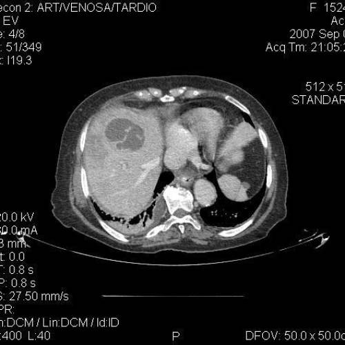 Abscesos Hepático 2
