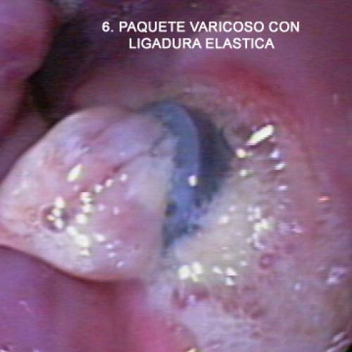 Varices Esofágicas