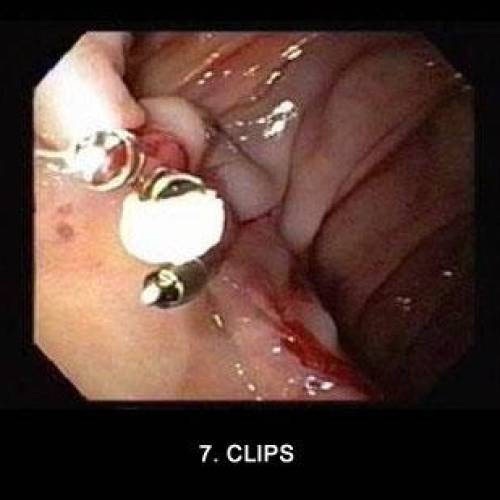 Anastomosis Gastroyeyunal
