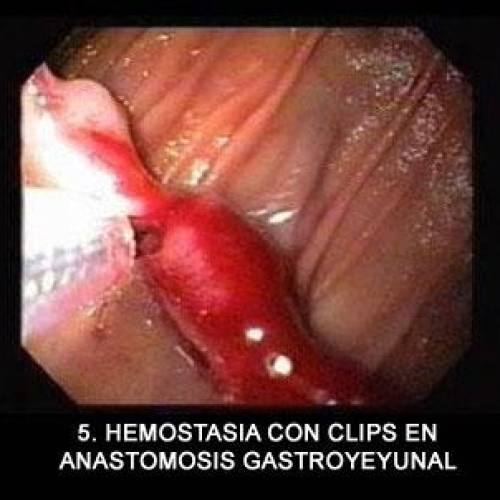 Anastomosis Gastroyeyunal