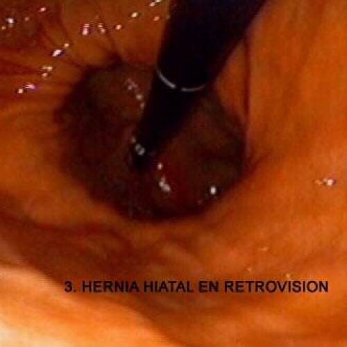 Hernia Hiatal