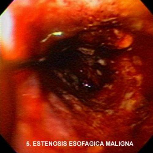 Estenosis Esofágica Maligna