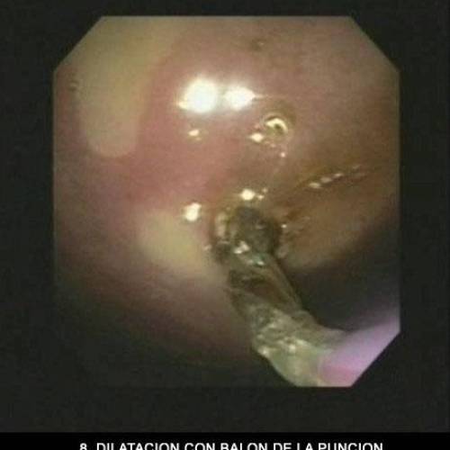 Pseudoquiste Páncreas