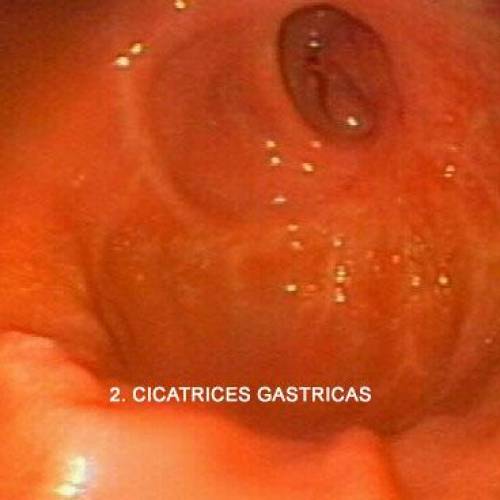 Cicatrices Gástricas