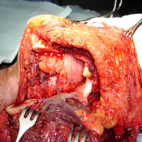 Tumor de parótida