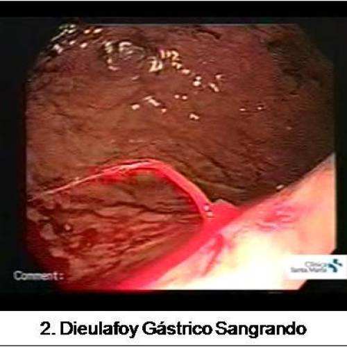 Dieulafoy Gástrico