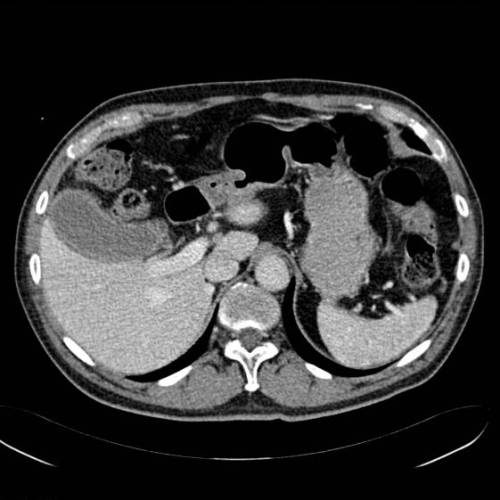 Colecistitis aguda y abseso hepático
