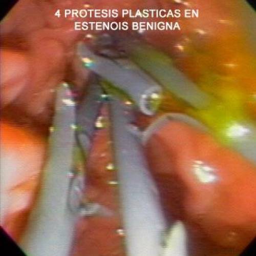 Prótesis