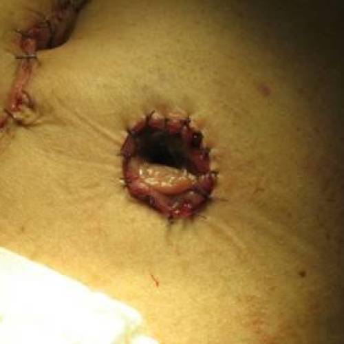 Colostomía