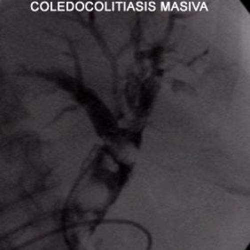 Coledocolitiasis