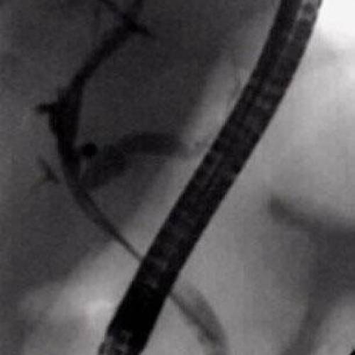 Estenosis maligna de Vía Biliar - Cancer de Vesicula