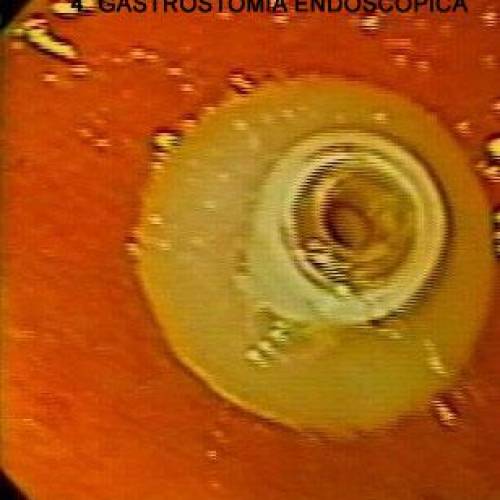 Gastrostomia