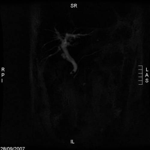 Coledocolitiasis