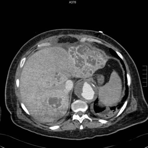 Abceso Hepatico