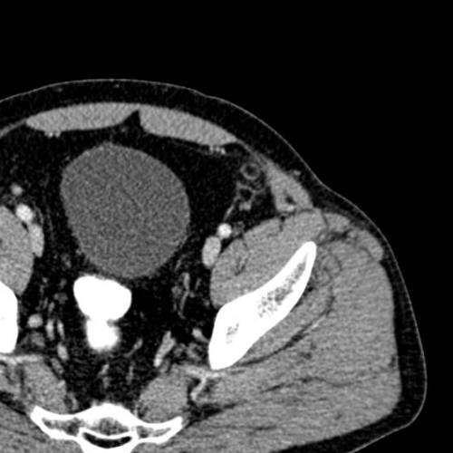Apendangitis
