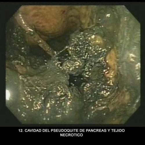 Pseudoquiste Páncreas