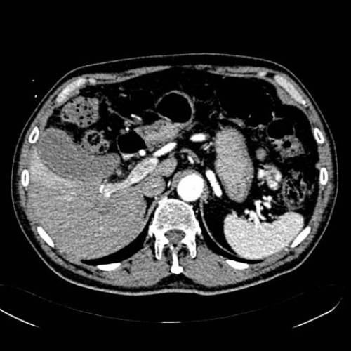 Colecistitis aguda y abseso hepático