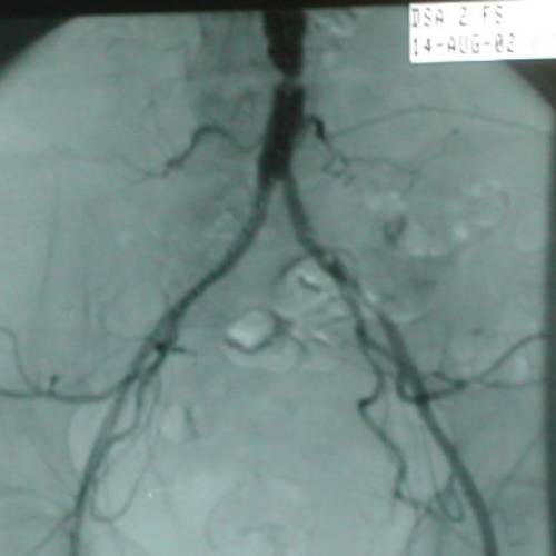 Angioplastia Aorta Abdominal