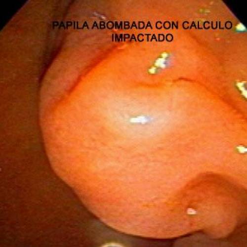 Precorte