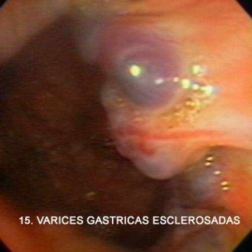 Várices Gástricas