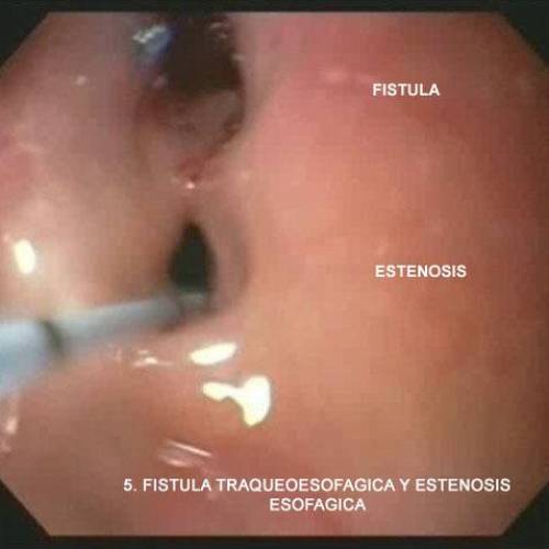Estenosis Esofágica y Fístula Traqueoesofágica