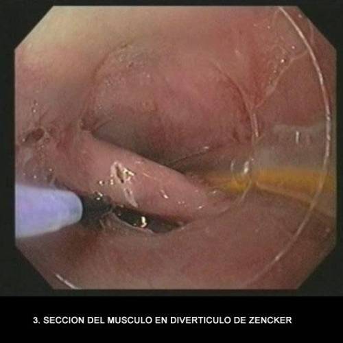 Divertículo de Zencker