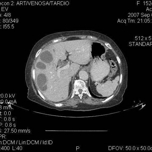 Abscesos Hepático 2