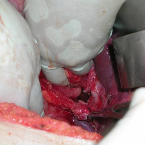 Hernia diafragmática