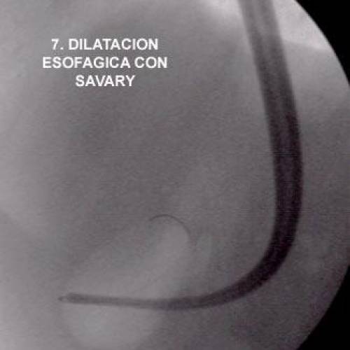 Dilatación Esofágica con Savary