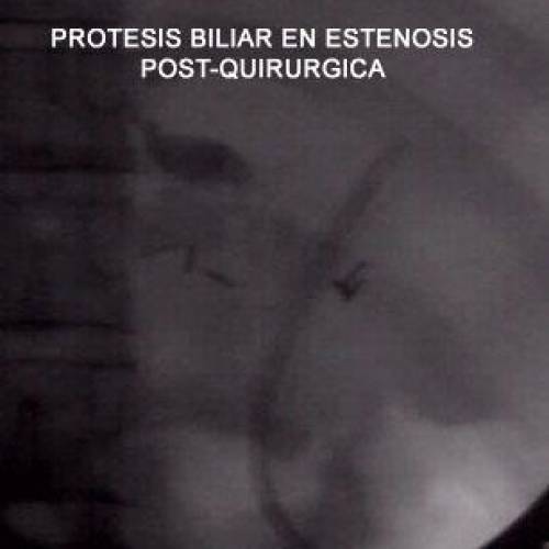 Prótesis