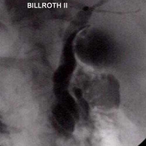 Coledocolitiasis en Billroth II