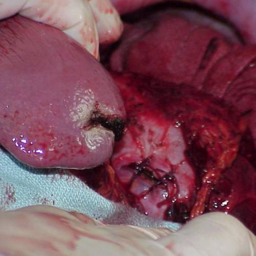 Penetrante tóracoabdominal