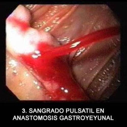 Anastomosis Gastroyeyunal