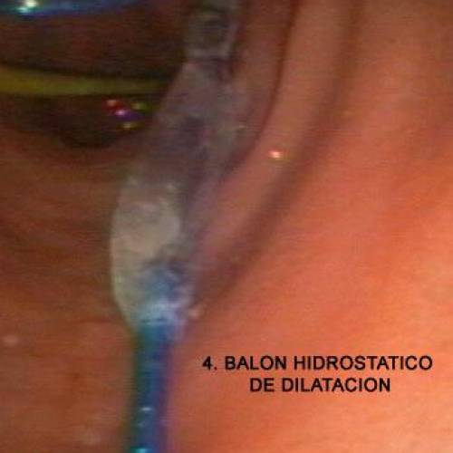 Divertículo de Zencker - Dilatación Esofágica con Balón