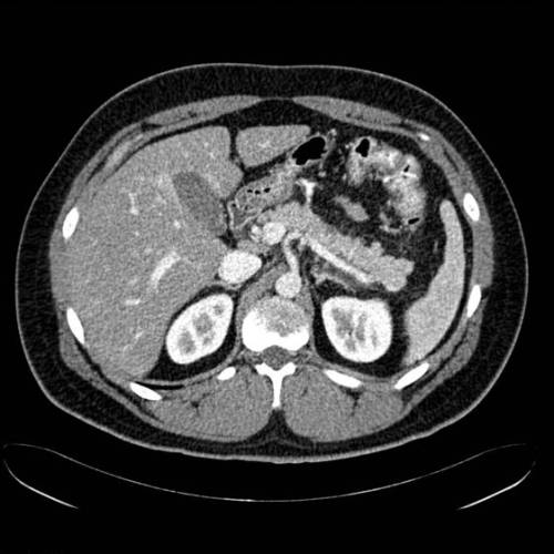 Pancreatits ag BB