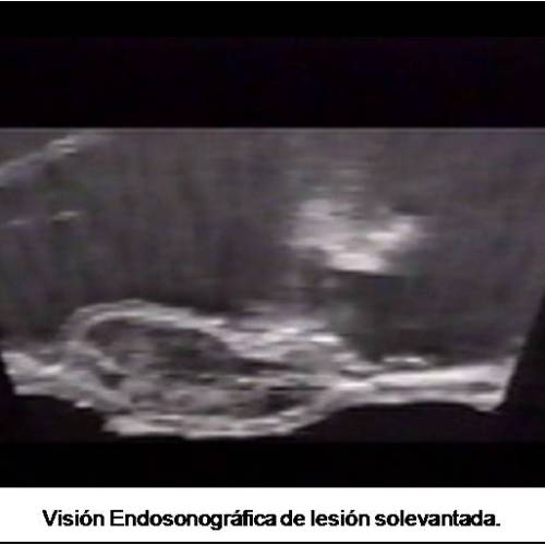 Mucosectomía Lesión Intramucosa