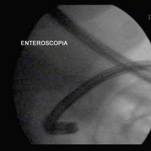 Enteroscopia