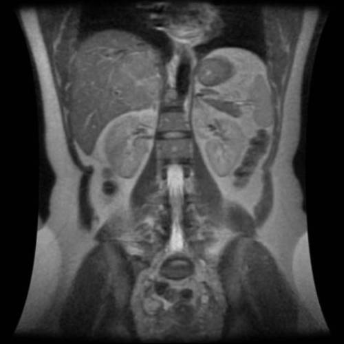 Hiperplasia Nodular Focal - RM