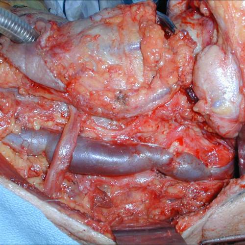 Disección de cuello