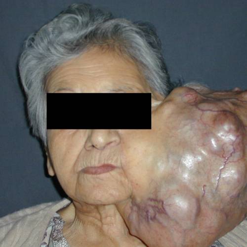 Tumor de parótida gigante