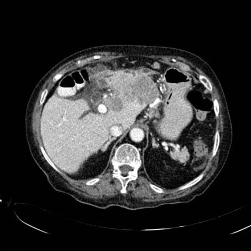 Colangiocarcinoma