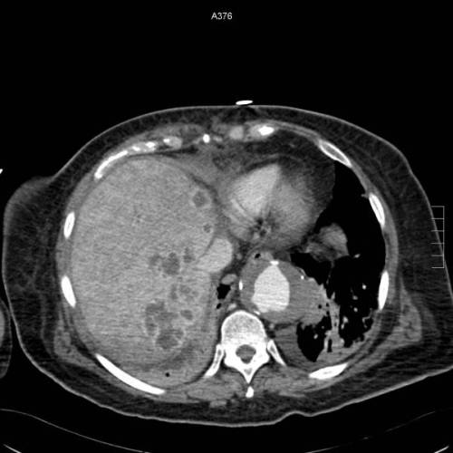 Abceso Hepatico