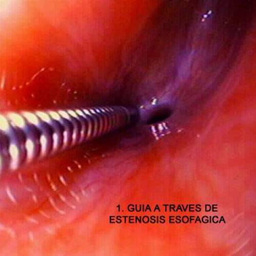Divertículo de Zencker - Dilatación Esofágica con Balón