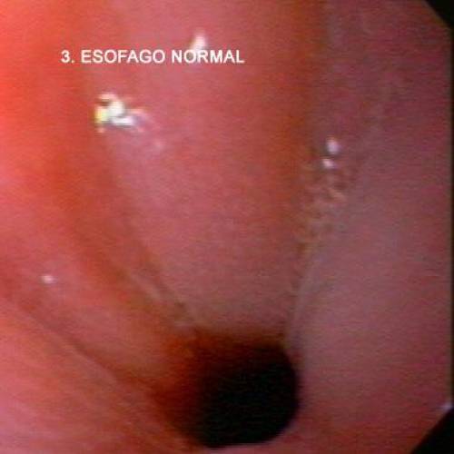Esófago Normal