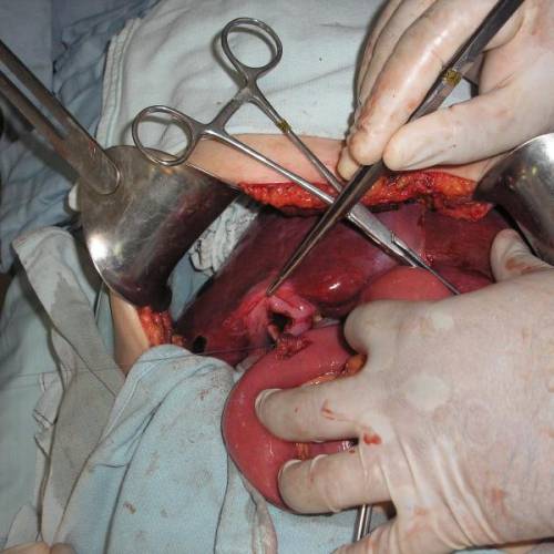 Colecisto yeyuno anastomosis