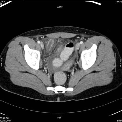 Peritonitis apendicular