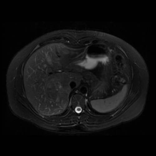 Hiperplasia Nodular Focal - RM