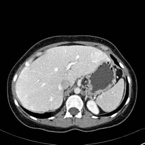Hiperplasia Nodular Focal - TAC